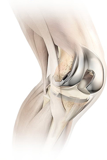 knee drawing with x-ray of bones